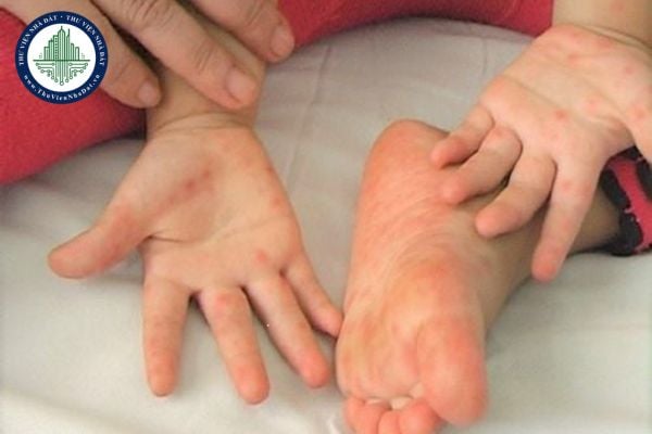 Một số biện pháp phòng chống bệnh tay chân miệng trong trường học?