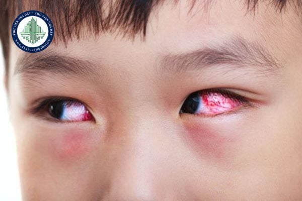 Kiểm tra, xử phạt các cơ sở lợi dụng dịch đau mắt đỏ để tăng giá thuốc? Nguyên nhân nào dẫn đến bệnh đau mắt đỏ?